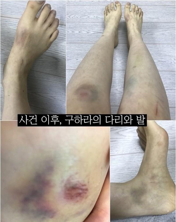 韩国女星被男友打到子宫出血，男方还坚持是女友对他施暴