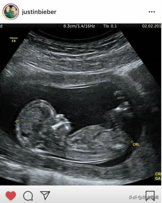 贾斯汀比伯宣布未婚妻海莉已怀孕，心情激动连发3张照片证实
