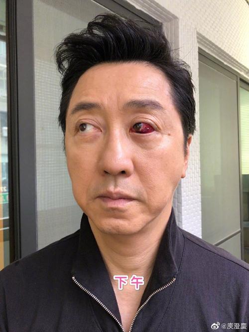 58岁庾澄庆左眼受伤照片曝光，网友：全是血太吓人了