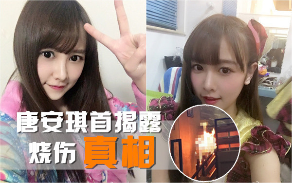 SNH48成员唐安琪首度回应烧伤事件 真相却是这样的……