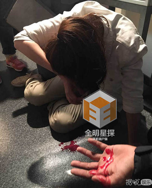 戚薇面部受伤自嘲刀疤七 这样做考虑过李承铉感受吗？
