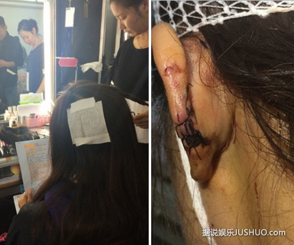 李依晓被狗咬伤关注度很少 叶璇却上热榜