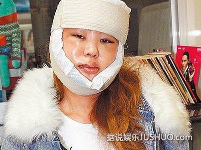 蓝心湄晒整容术后照面部浮肿 大方承认整容