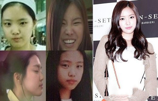 孙娜恩整容对比前后照片塌鼻子大饼脸容貌变化