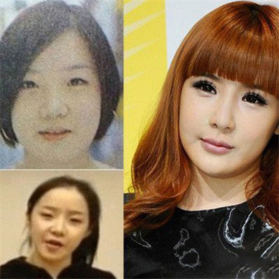 朴春整容前后大对比超夸张 双眼皮宽的惊人