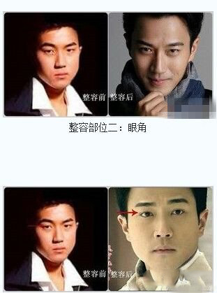 刘恺威整容变化大 粉丝抱怨TVB没眼光 刘恺威整容变化大 粉丝抱怨TVB没眼光